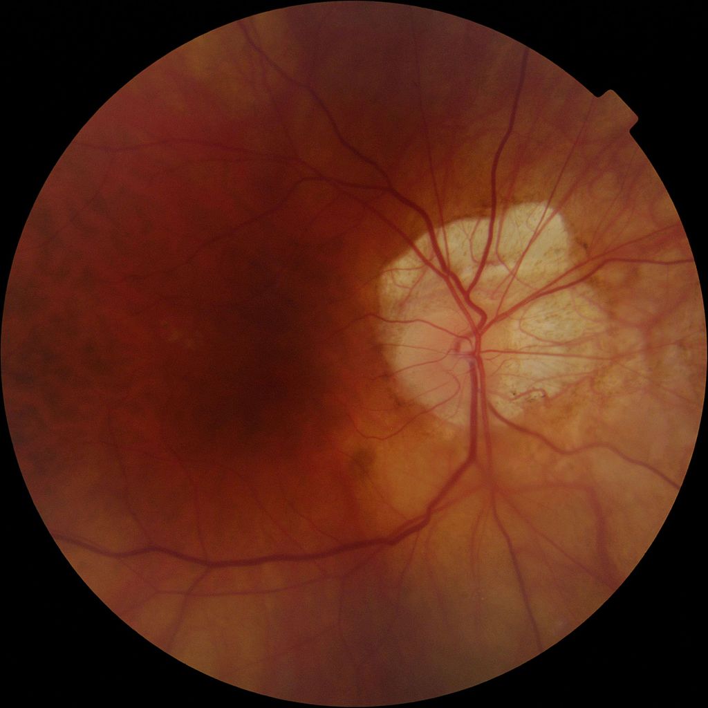 optic-disc-tilt-may-predict-glaucoma-progression-in-a-subset-of