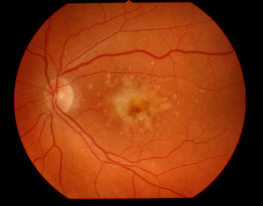 age related macular degeneration with hemorrhage and geographic atrophy