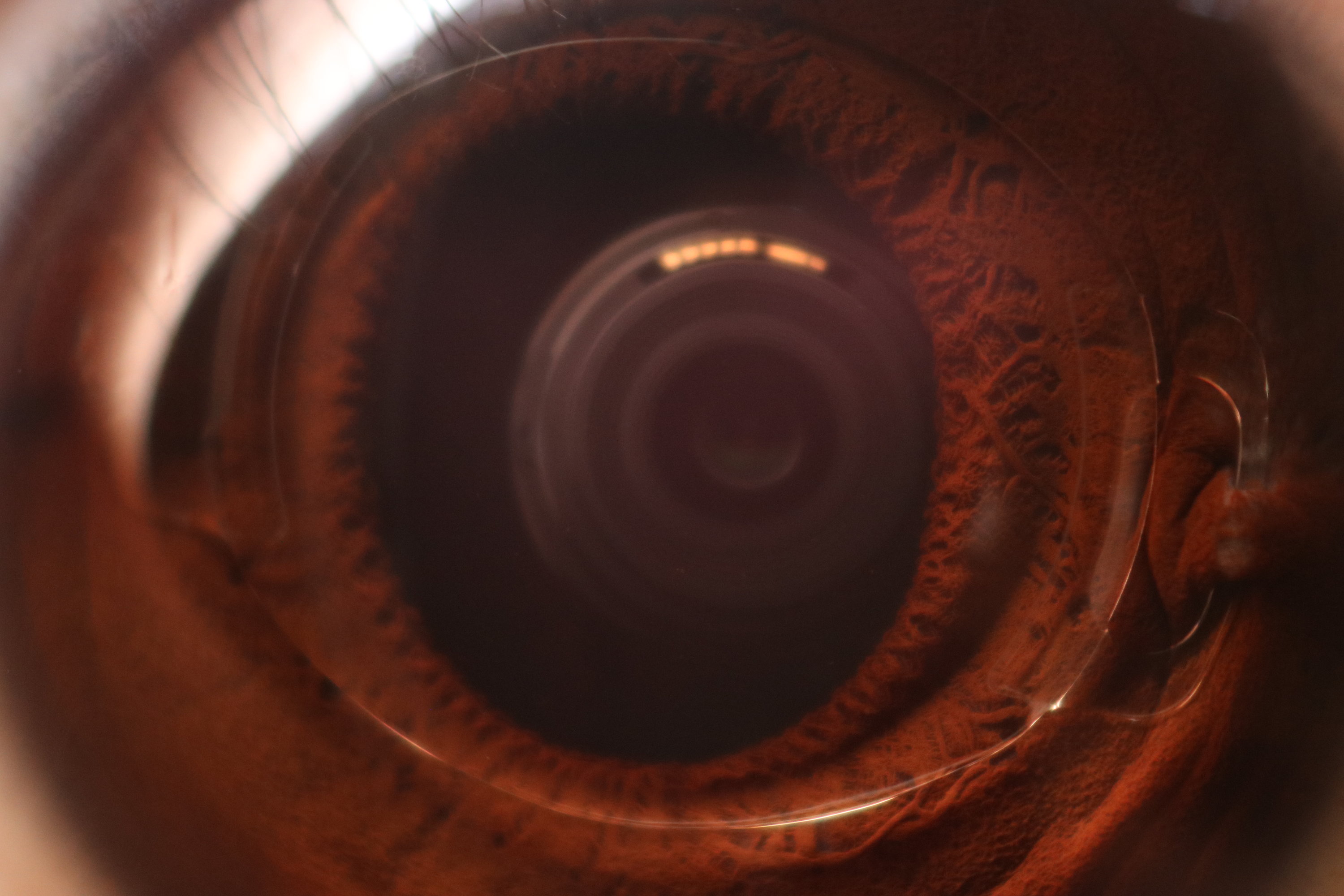 Intraocular Lens In A Phakic Eye
