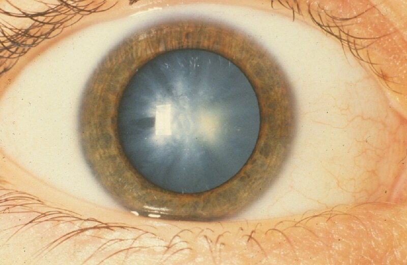 Congenital Eye Cataract